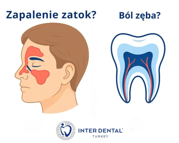 Zapalenie zatok czy ból zęba? Ilustracja przedstawia profil twarzy z zaznaczonymi zatokami oraz przekrój zęba z widocznymi nerwami.