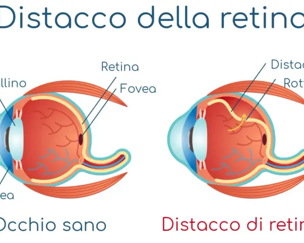 Illustrazione occhio sano vs distacco di retina, con rottura. Un intervento distacco retina non riuscito può portare a complicazioni.