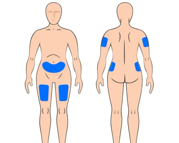 Körperstellen für Injektionen: Bauch, Oberschenkel, Oberarme und Gesäß. So kann man weit spritzen.