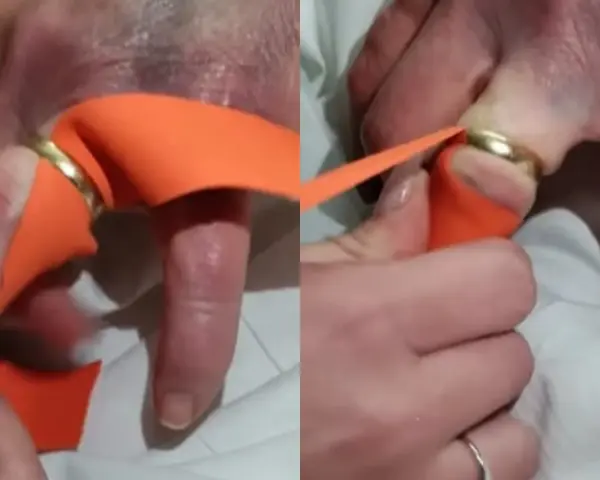 Pomoc w zdjęciu pierścionka z bardzo spuchniętego palca za pomocą pomarańczowej wstążki. Technika ta pomaga zmniejszyć obrzęk.