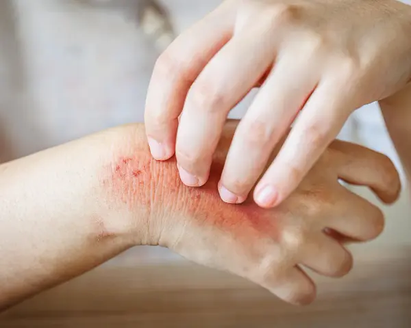 Juckende Haut: Ein Ekzem an der Hand, das durch Kratzen verschlimmert wird.