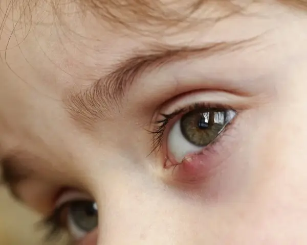 Occhio di bambino con un orzaiolo, segno di stress o stanchezza.