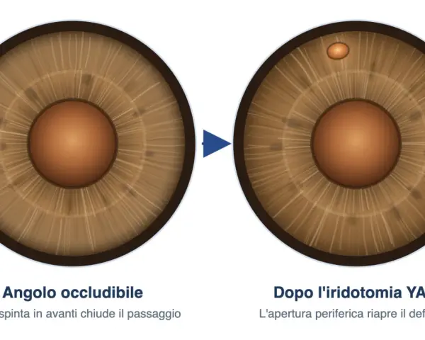 Iridotomia YAG: prima occlusione dell'angolo, dopo apertura per riaprire il deflusso. Valutare i rischi.
