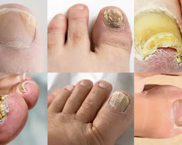 Gros plans de plusieurs orteils montrant différents stades de mycose de l'ongle, avec des ongles jaunis, épaissis et déformés.