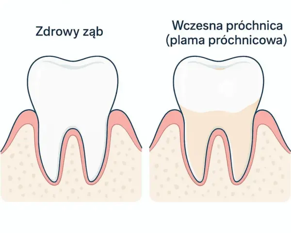 Zdrowy ząb obok zęba z wczesną próchnicą, czyli plamą próchnicową. Dentysta widzi różnicę w kolorze i strukturze szkliwa.