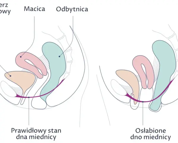 Ilustracja pokazuje różnicę między prawidłowym a osłabionym dnem miednicy, co może wpływać na wypadanie macicy. Domowe sposoby mogą pomóc wzmocnić mięśnie.