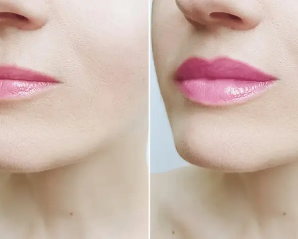 Przed i po zabiegu botox lip flip. Usta po zabiegu są pełniejsze i bardziej wyraziste.