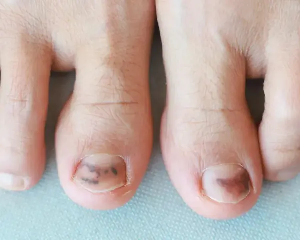 Gros plan sur des orteils, dont deux présentent un hématome sous l'ongle. La durée et la douleur de cet hématome sont visibles.
