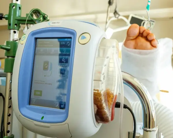 V.A.C.® Therapy Gerät mit gefülltem Behälter und einem Fuß im Verband. Die vac pumpe unterstützt die Wundheilung.