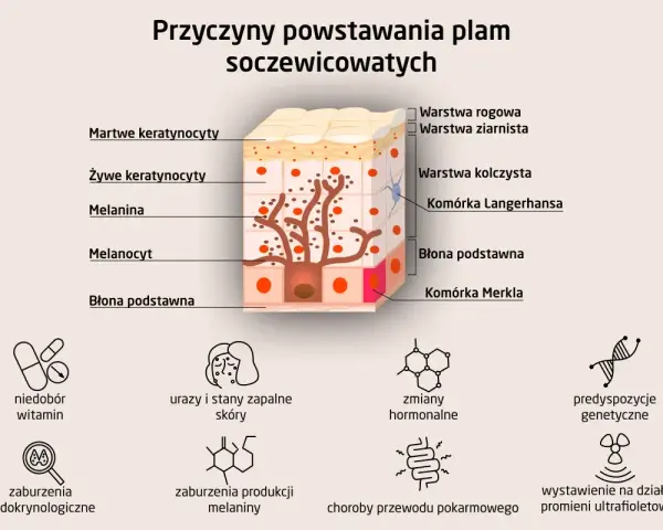 Schemat wyjaśnia, jak wyglądają plamy wątrobowe, pokazując budowę skóry i czynniki wpływające na powstawanie przebarwień.