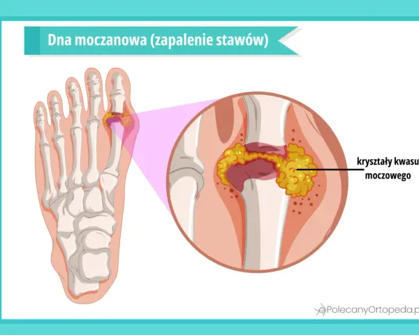 Dna moczanowa: kryształy kwasu moczowego gromadzą się w stawie palucha, powodując zapalenie.