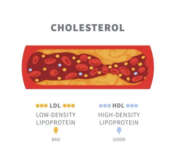Niski cholesterol LDL sprzyja miażdżycy, tworząc złogi w naczyniach. Wysoki HDL chroni.