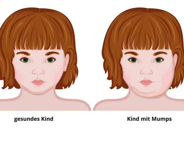 Mumps-Symptome: Erkennen, Verlauf & Komplikationen | Was tun?