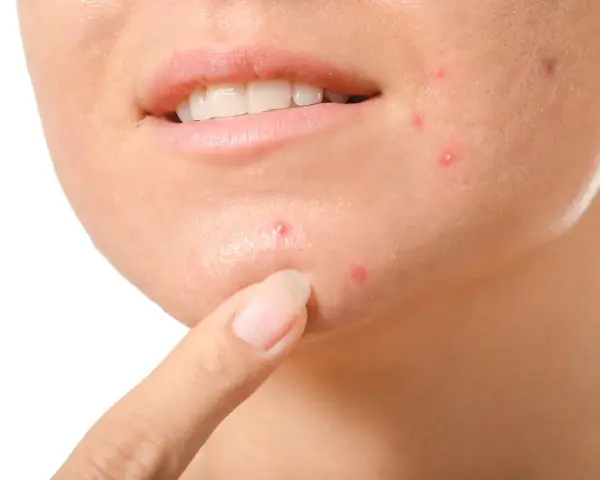 Primo piano del viso di una persona con evidenti segni di acne cistica sul mento e sulla guancia, con un dito che indica una lesione.