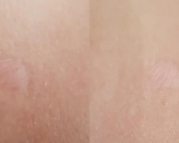 Jasna skóra z widocznymi, lekko zaróżowionymi bliznami po depilacji laserowej.