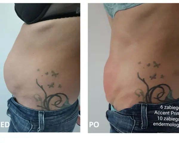 Przed i po zabiegu Accent Prime. Widoczna redukcja tkanki tłuszczowej brzucha, co pokazuje skuteczność liposukcji kawitacyjnej.