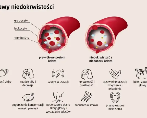 Prawidłowy poziom żelaza w naczyniu krwionośnym vs. niedobór żelaza. Objawy anemii: bladość, zmęczenie, szumy w uszach, bóle głowy.