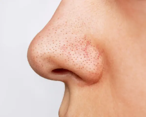Gros plan sur un nez avec de nombreux points noirs visibles.