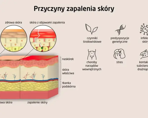 Ilustracja porównująca zdrową skórę i skórę z zapaleniem, z ikonami przedstawiającymi przyczyny AZS.
