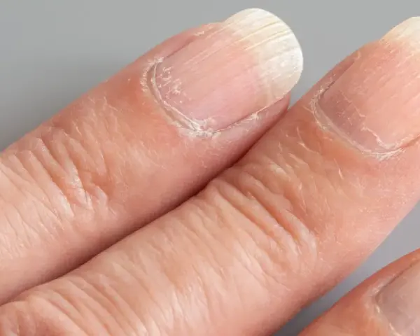 Gros plan sur des doigts montrant des ongles striés verticalement. La signification de ces ongles striés peut varier.