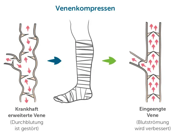 Venenkompression: Von erweiterter Vene mit gestörter Durchblutung zur eingeengten Vene mit verbesserter Blutströmung. Eine Alternative zur Thrombosespritze.
