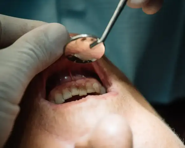 Usta pacjenta z widocznym zaczerwienieniem i obrzękiem dziąseł, wskazującym na nieleczony ropień zęba. Dentysta bada jamę ustną lusterkiem.