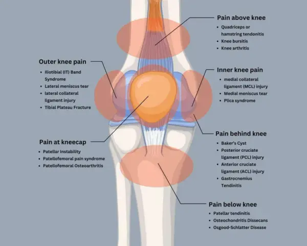Diagram showing knee pain locations and causes. Excessive spinning can be bad for your knees, leading to issues like IT band syndrome or meniscus tears.