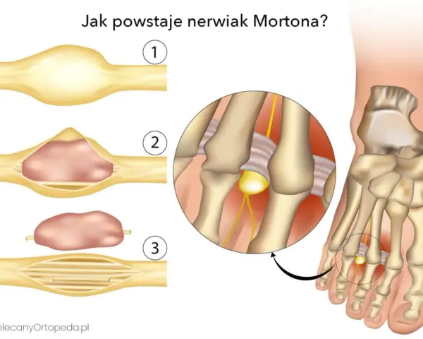 Ilustracja pokazuje powstawanie nerwiaka Mortona, który może powodować zapalenie śródstopia. Objawy to ucisk na nerw.
