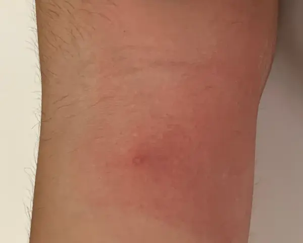 Piel enrojecida con una pequeña protuberancia, indicativa de picaduras chinches de cama como eliminarlas.