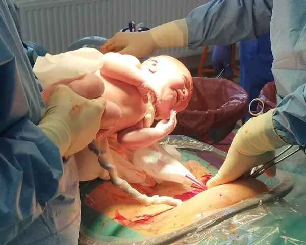Noworodek wychodzi z brzucha mamy, ręce lekarzy pomagają w porodzie, który był w położeniu miednicowym.