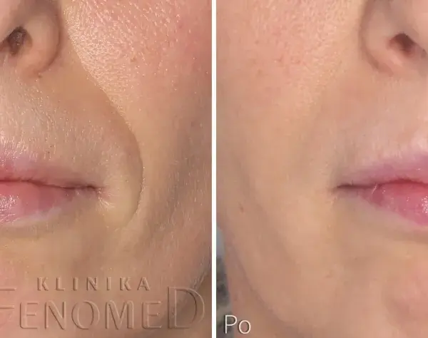1 ml kwasu hialuronowego: Co naprawdę zmieni w Twojej twarzy?