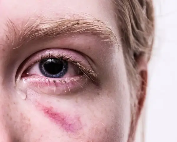 Zaczerwienione oko z siniakiem pod spodem, łza spływająca po policzku. Ból oka po uderzeniu jest widoczny.