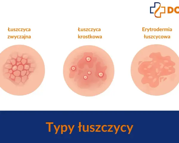 Ilustracje pokazują różne typy łuszczycy: zwyczajną, krostkową i erytrodermię łuszczycową. Ważne, by znać objawy łuszczycy u dzieci.