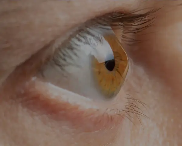 Occhio con iride ambrata e pupilla nera. La cornea deformata riflette la luce, creando un effetto visivo particolare.