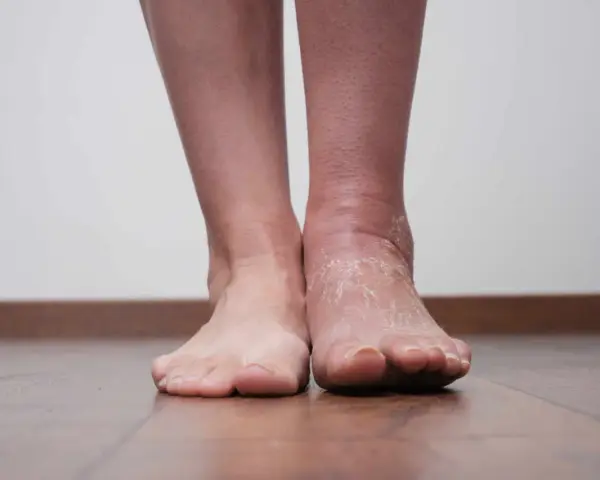 Stopy, jedna opuchnięta z łuszczącą się skórą, druga normalna.