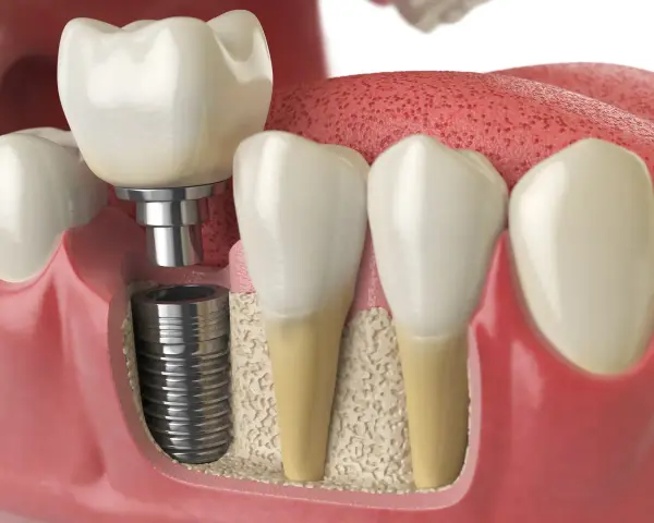 Implant dentystyczny z tymczasową plombą, pokazujący proces integracji z kością szczęki.