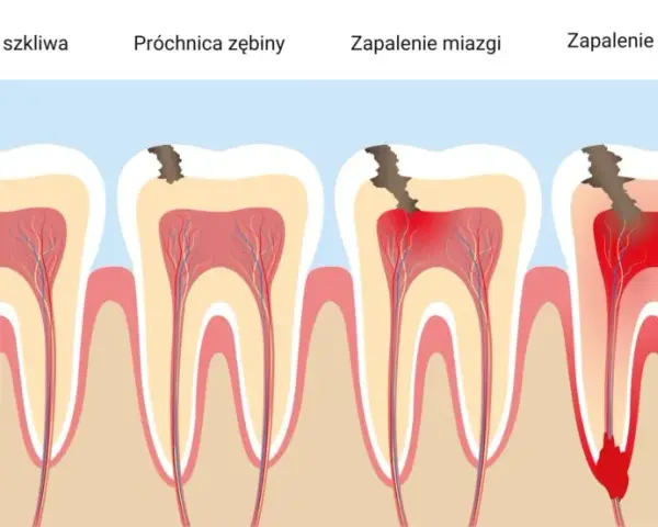 Co wziąć na ból zęba? Skuteczne leki i domowe sposoby na ulgę