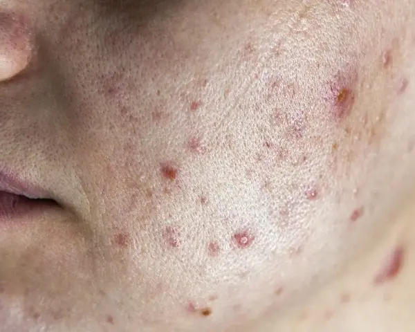 Primo piano della pelle con acne, inclusi diversi brufoli cistici e rossori.