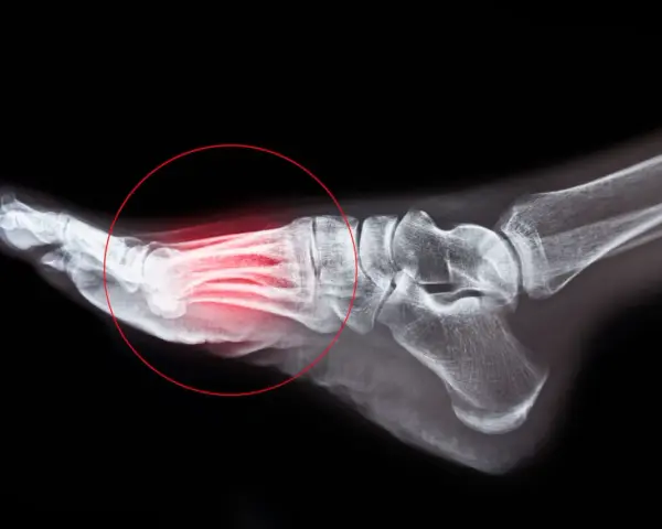 Radiographie du pied montrant une fracture de fatigue métatarsienne, avec une zone rouge indiquant la douleur. Le temps de guérison est essentiel.