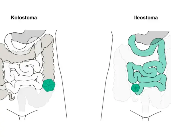 Vergleich von Kolostoma und Ileostoma: zwei stoma arten, die den Darm betreffen.