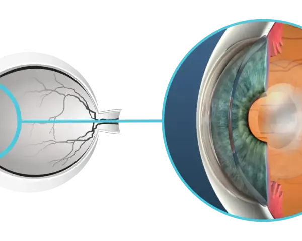 Sezione dell'occhio che mostra la lente e la retina. Si notano aloni dopo capsulotomia, un effetto visivo comune.