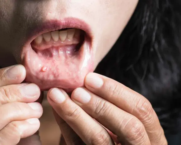 Una persona se revisa la boca, mostrando unos pequeños granos en los labios internos.