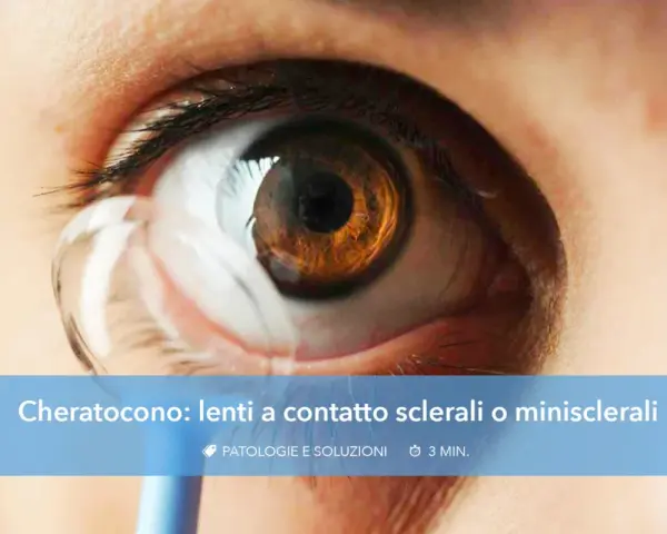 Occhio con cheratocono e lente a contatto applicata. Soluzioni per la visione con cheratocono.