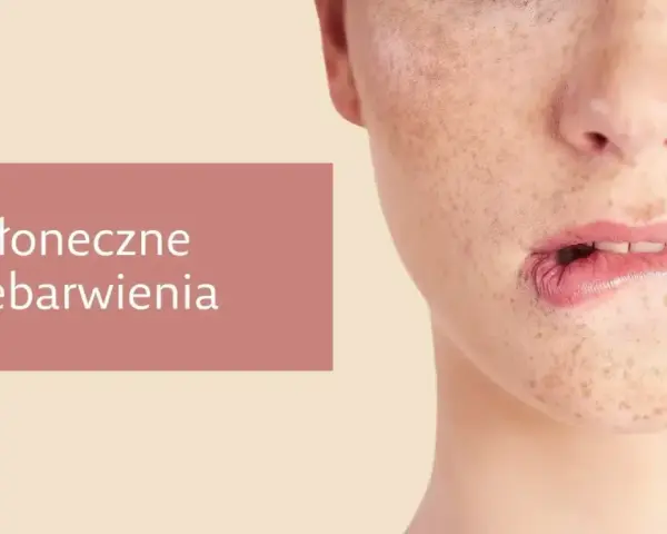 Jak poprawić koloryt cery? Widok zbliżenia na twarz z widocznymi przebarwieniami i piegami.