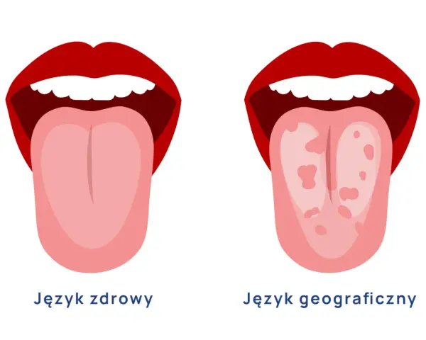 Dwa języki: zdrowy, gładki i geograficzny z plamkami, jakby żaba na języku zostawiła ślady.