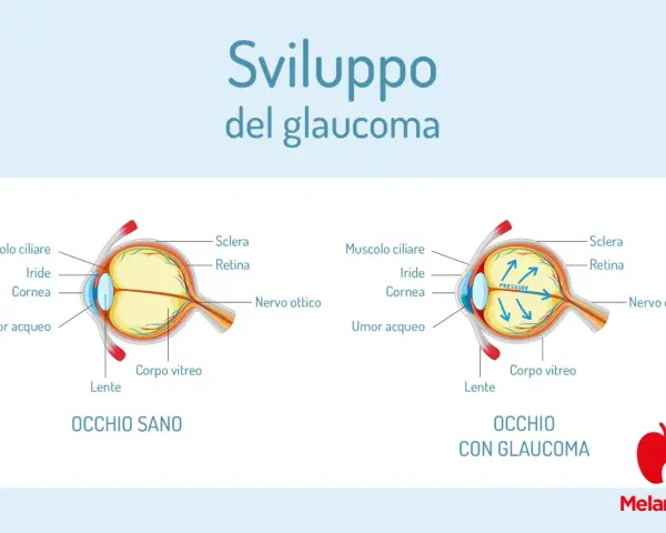 Confronto tra occhio sano e occhio con glaucoma, illustrando l'aumento di pressione. Il termine "abbigliamento significato" non si applica qui.