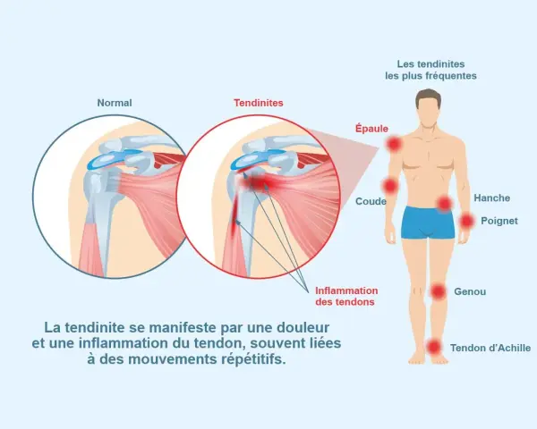 Illustration montrant une tendinite à l'épaule, une inflammation des tendons. L'ibuprofène peut aider à soulager ces douleurs.