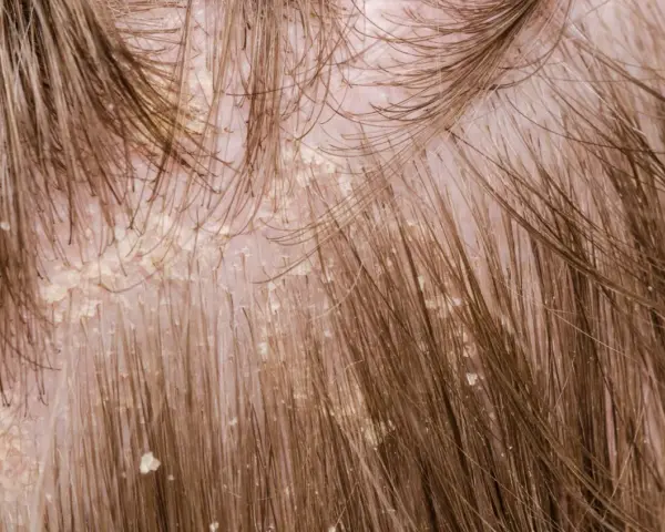 Nahaufnahme der Kopfhaut mit sichtbaren gelblichen Krusten und Schuppen, die sich zwischen den braunen Haaren abzeichnen.