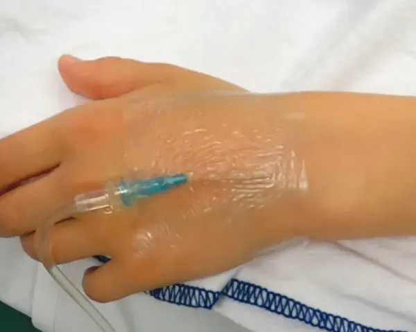 Ein Zugang am Handrücken, wo tut ein zugang am wenigsten weh? Hier wird ein Infusionsschlauch an einer Hand befestigt.