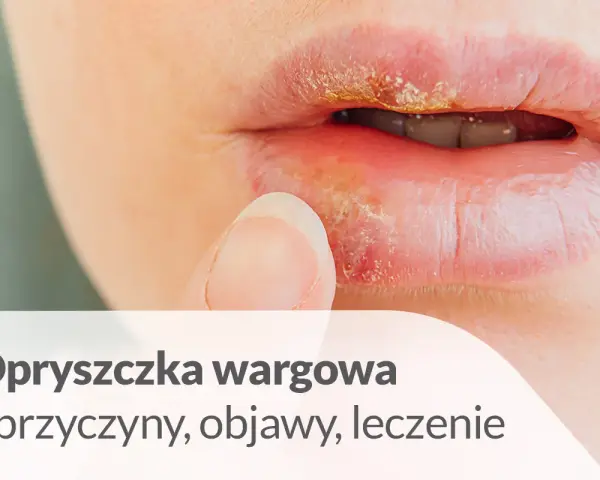 Zbliżenie na usta z widoczną opryszczką wargową. Palec wskazujący delikatnie dotyka wargi.